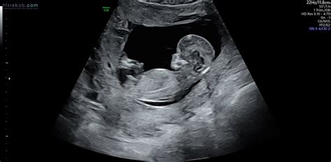 12 Week 3d Ultrasound Boy