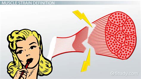 Muscle Strain | Definition, Symptoms & Treatment - Lesson | Study.com