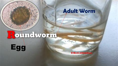 Roundworms In Stool