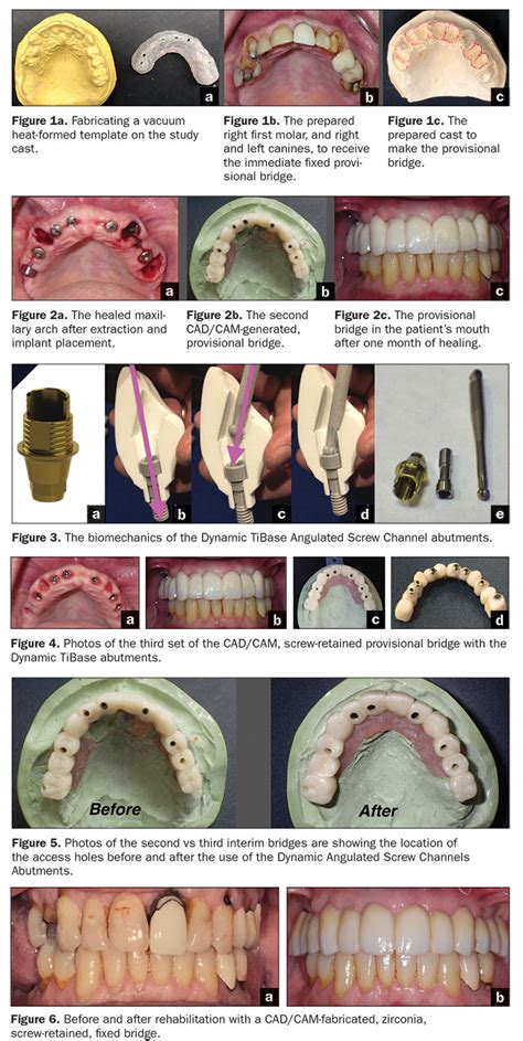 Dental Bridge Abutment