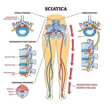 Chronic Sciatica: Causes, Symptoms and Treatment - Chiropractic ...