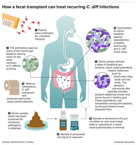 Infographic: How fecal transplants work against recurrent C. diff ...