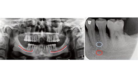 Mandibular Foramen Radiograph