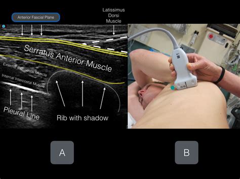 Serratus Anterior Plane (EASY) — Highland EM Ultrasound Fueled pain ...