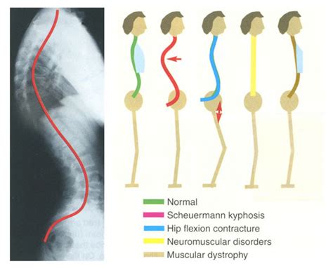 SCOLIOSIS INDIA: Kyphosis Exercises