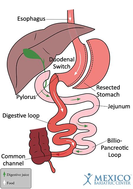 SADi-S vs BPD/DS: Comparing Types of Duodenal Switch Surgery