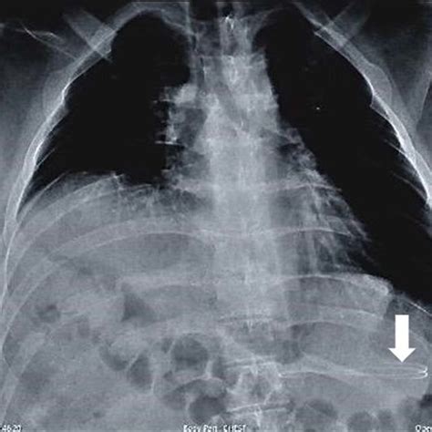 Chest X-ray showing a ventriculoperitoneal (VP) shunt catheter in the ...