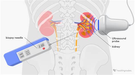 Kidney Biopsy: Purpose, Procedure, and What to Expect