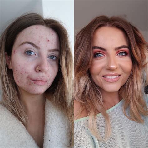 This foundation is going viral after cystic acne sufferer shares her ...