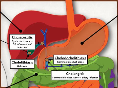 Cholelithiasis, Gallbladder, Gastrointestinal disorders