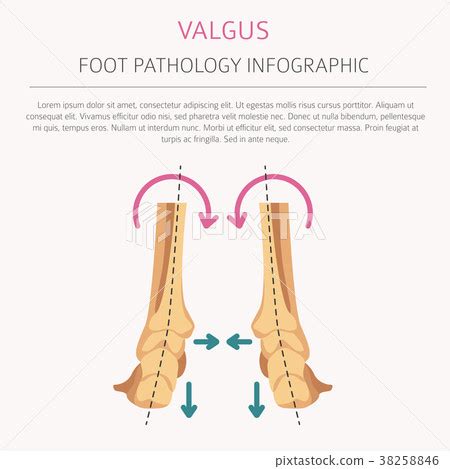 Varus Vs Valgus Fracture