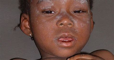 50,000 Madagascar Residents Got Measles in One Year Due to Lack of ...