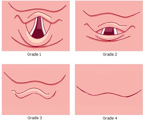 Airway — Pulmcast