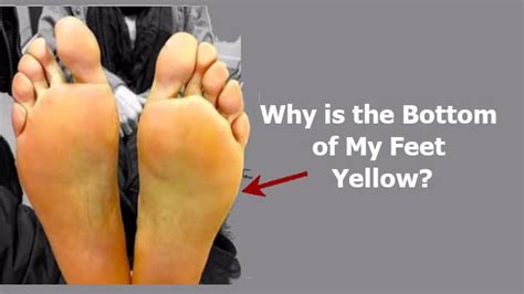 Bottoms of Feet Yellow: Why is the Bottom of My Feet Yellow?