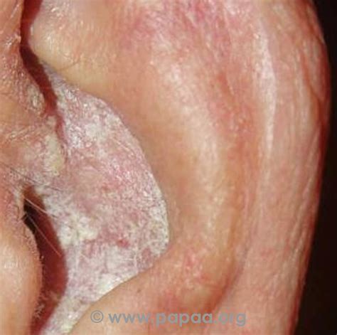 Plaque Psoriasis Ears