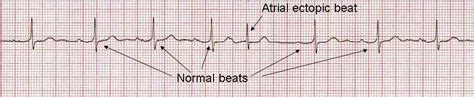 Extra heartbeat - sworldmyte