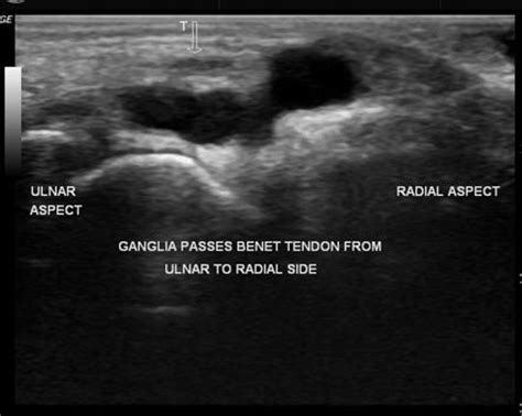 Ganglion Cyst Wrist Ultrasound