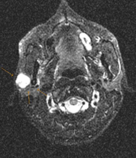 Pleomorphic Adenoma-MRI - Sumer's Radiology Blog