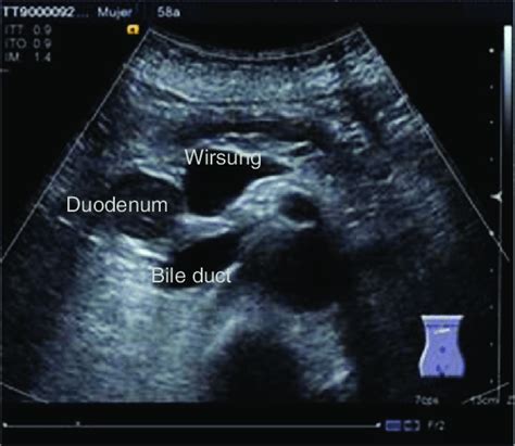 Pancreatic Duct Ultrasound