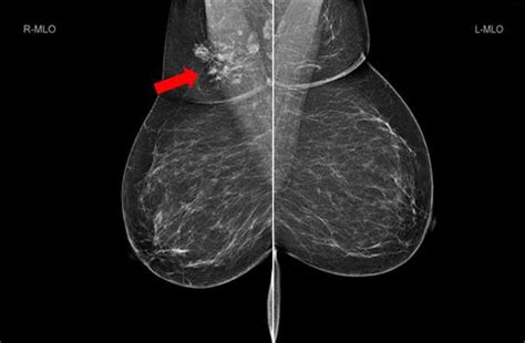 Bilateral mammogram shows mixed density glandular breast tissue with no ...