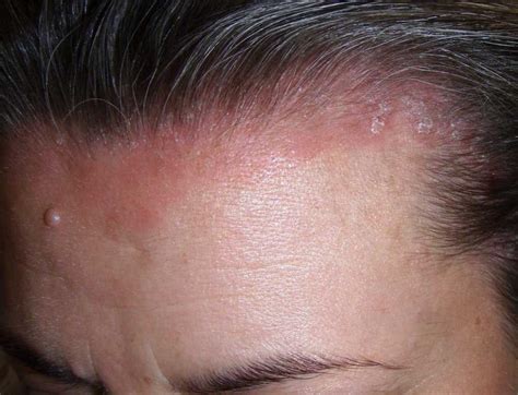 Mild scalp psoriasis pictures | Symptoms and pictures