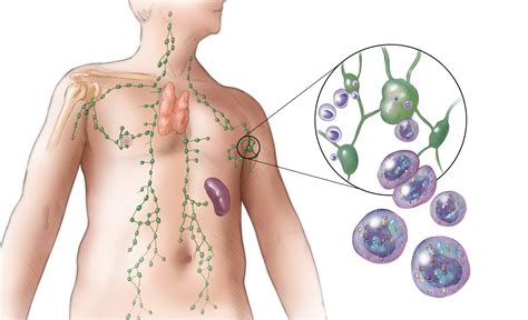 Determining Prognosis for Patients With Diffuse Large B-Cell Lymphoma ...