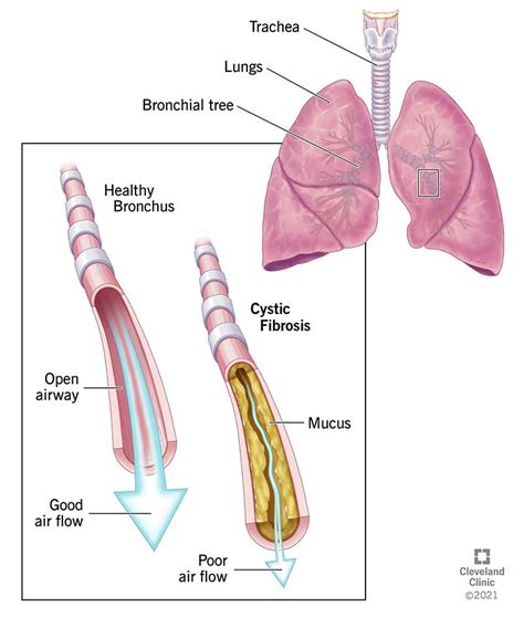 Cystic Fibrosis (CF): Causes, Symptoms, Diagnosis & Treatment