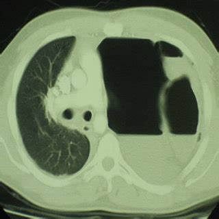 CT scan shows a left hydropneumothorax, total collapse of the left ...