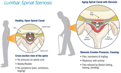 Spinal Stenosis Causes Symptoms Diagnosis Treatment And Exercises ...