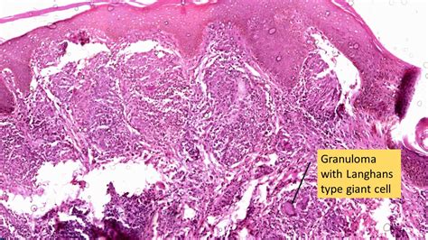 LEPROSY- Tuberculoid & Lepromatous | Pathology Made Simple