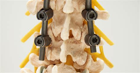 CTNav technique increases accuracy of pedicle screw placement compared ...