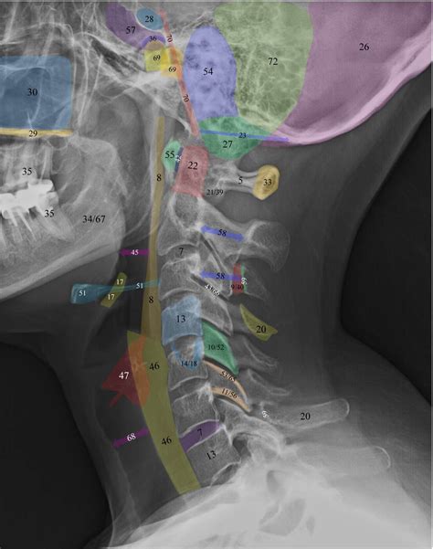 Normal Radiographic Anatomy of the Cervical Spine | Anatomy, Radiology ...