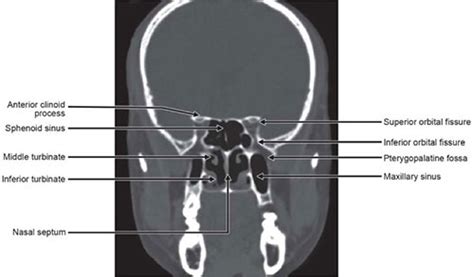 Superior Orbital Fissure Radiology