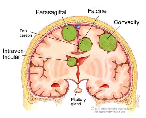 48 best Meningioma images on Pinterest