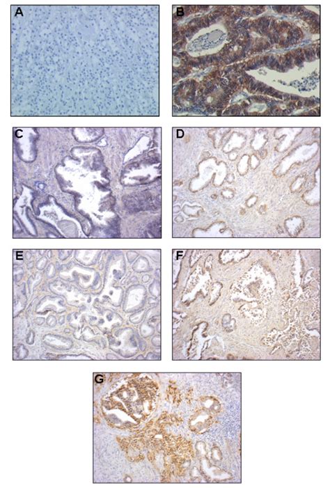 Different EGFR pattern of expression in normal and PCs tissues revealed ...