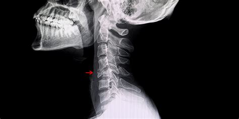 Lumbar Compression Fracture X Ray