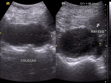 Perinephric abscess drainage | Image | Radiopaedia.org