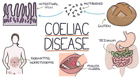 Celiac Disease: Causes, Symptoms, and Diet | September 2023