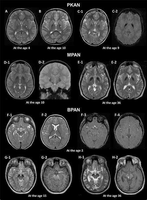 Abnormal Brain MRI Results