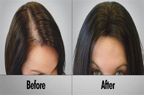 Best Hair Loss Treatment for Female | Hairstyles & Hair Color for long ...