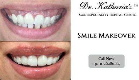 Smile Makeover In An Hour at Delhi, India | Smile makeover, Dental ...