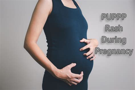 PUPPP Rash During Pregnancy: Causes, Symptoms And Treatment - Being The ...