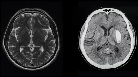 Imaging in stroke | Strokeforum