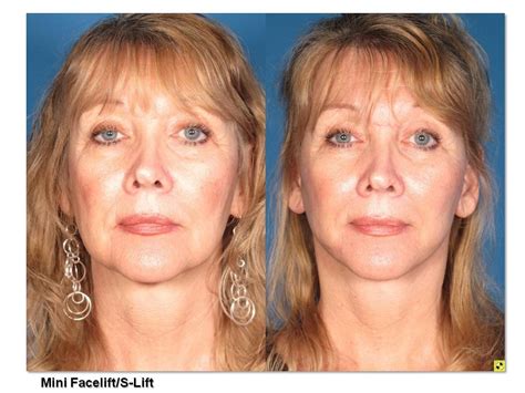 Mini Facelift/S-Lift Before & After Photos - Summit Plastic Surgery ...