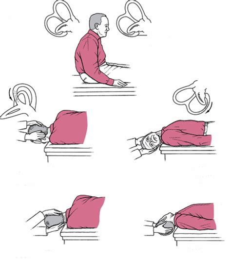 Epley Maneuver Vs Dix Hallpike