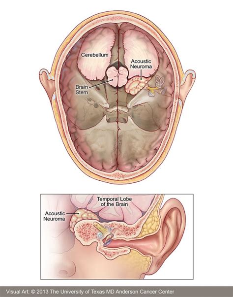 Beautiful Tips About How To Diagnose Acoustic Neuroma - Icecarpet