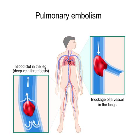 Pulmonary Embolism Treatment in Denver, CO | MIPS Cardiology Center