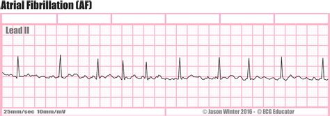 ECG Educator Blog : Atrial Rhythms