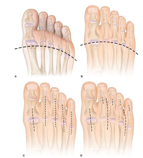 Master Techniques in Surgery: Foot Sparing-Amputations - DF Blog