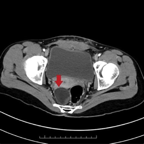 Pelvic CT scan revealed a cystic lesion at the pararectal region with ...